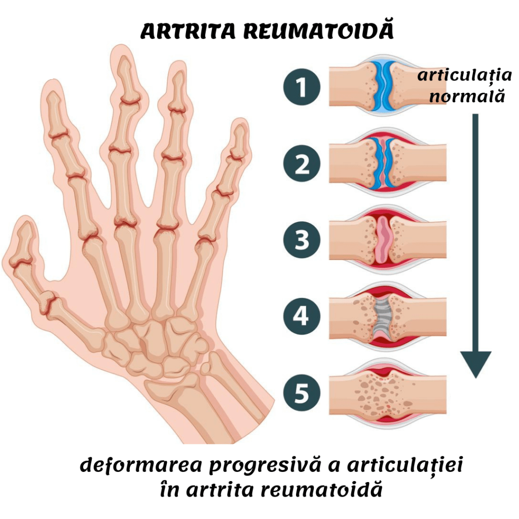 osteoartrita încheieturii mâinii